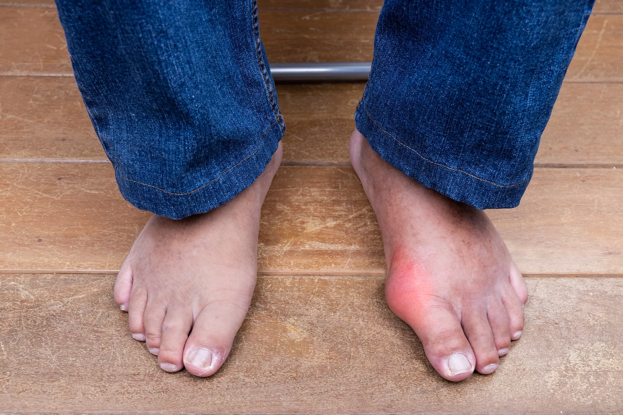 Gout in Colorado 101: Your Guide to Understanding This Debilitating Foot Pain