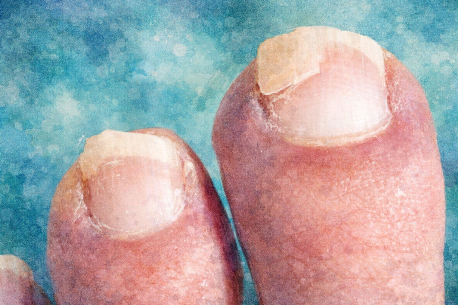 What Is Nail Trauma? Causes, Symptoms, and When to See a Specialist