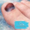 Subungual Hematoma