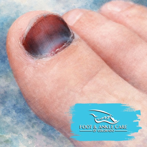 Subungual Hematoma From Sports Injuries: How Foot & Ankle Care Of Colorado Can Help