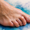 hammer toe