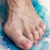 hammer toe