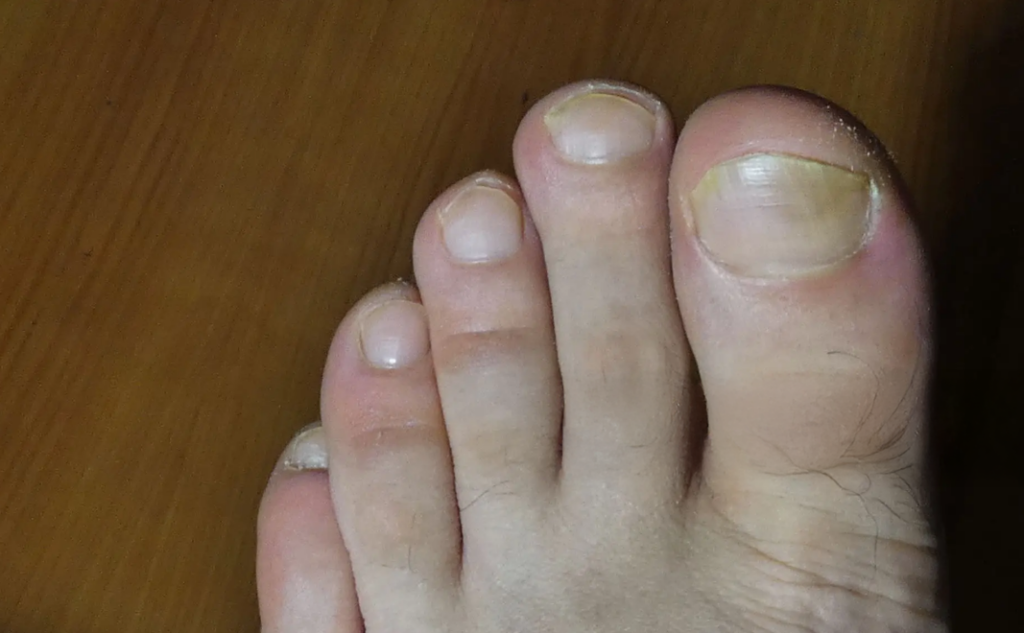Ingrown Toenails