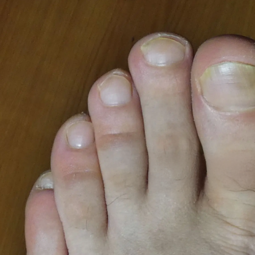 Ingrown Toenails
