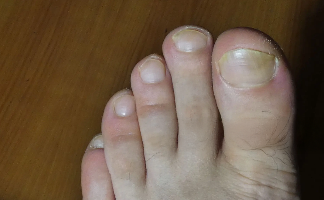 What Causes Ingrown Toenails And What Treatment Options Are Available?