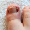 Ingrown Toenails