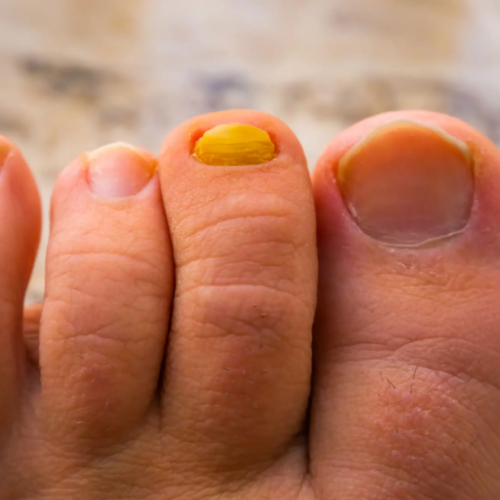 ingrown toenails
