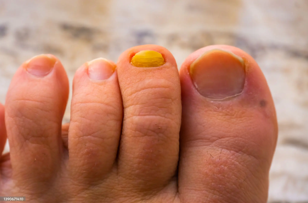ingrown toenails