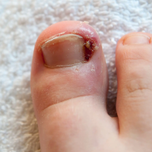 Ingrown Toenails
