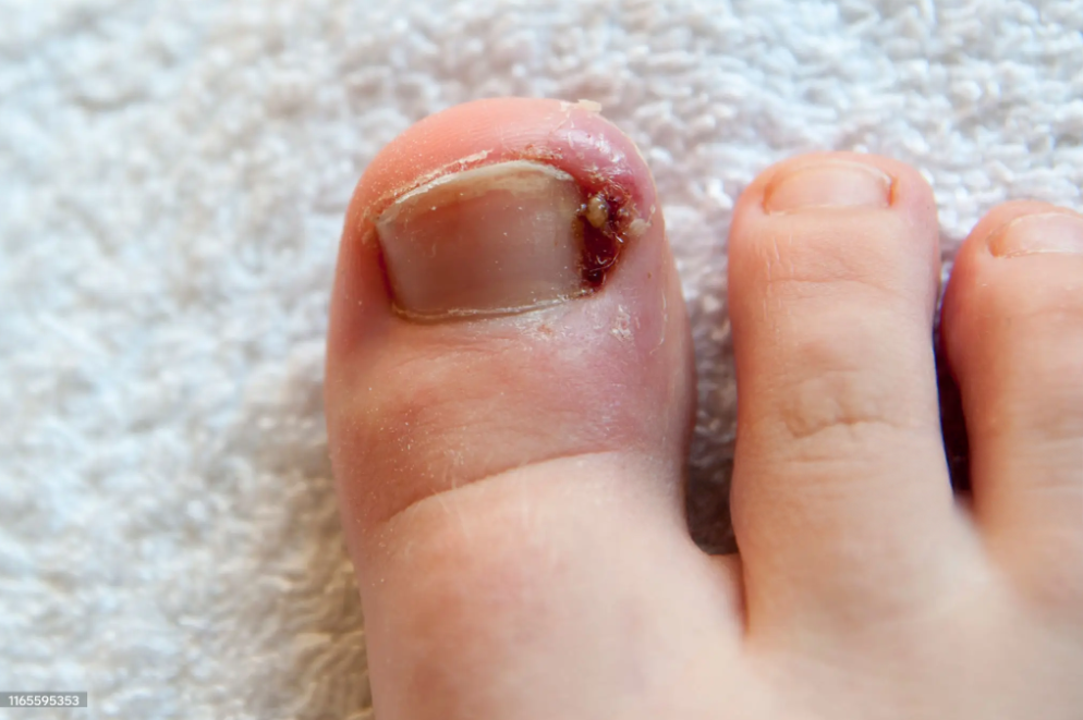 Ingrown Toenails