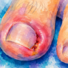 ingrown toenail